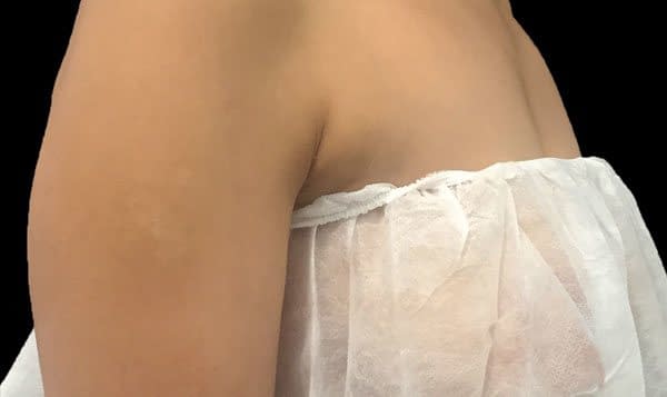 After Treatment Breast