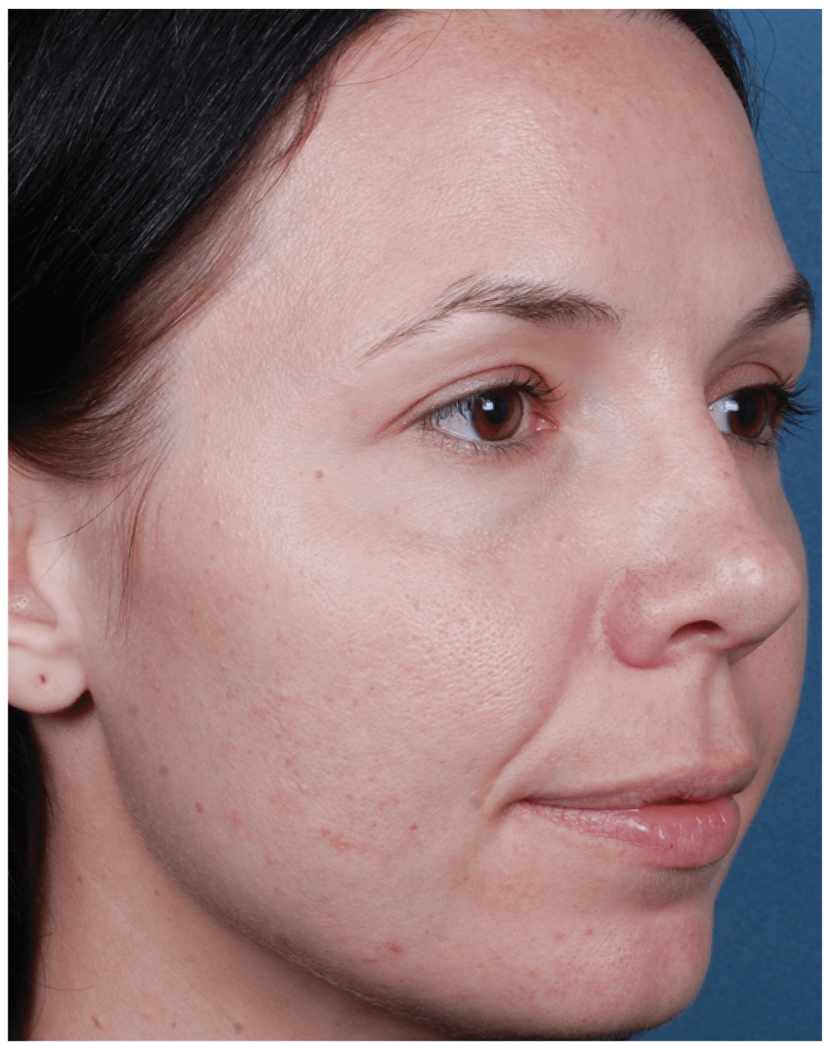 Before and After-Obagi Blue Peel