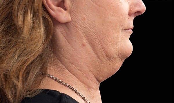 chin Before Treatment