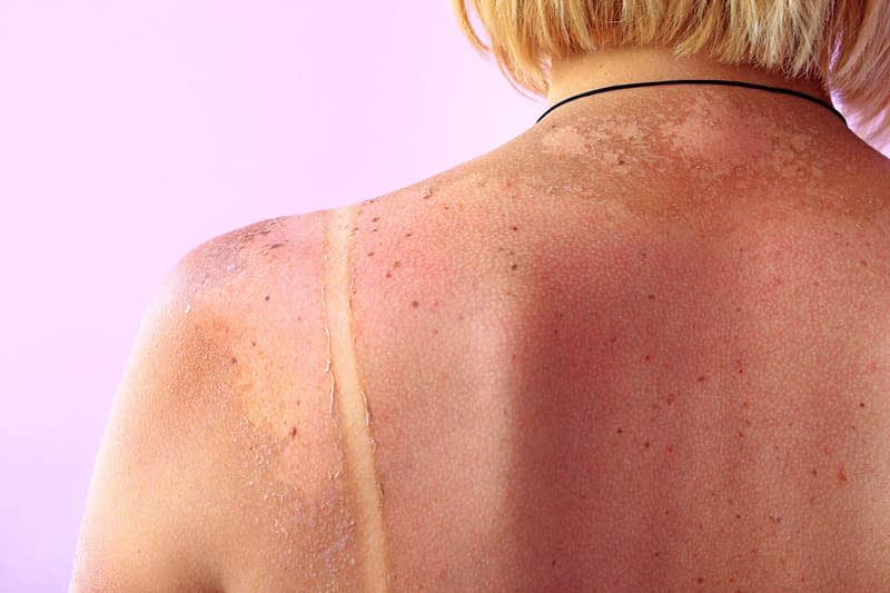 Sun Damage and Age Spots