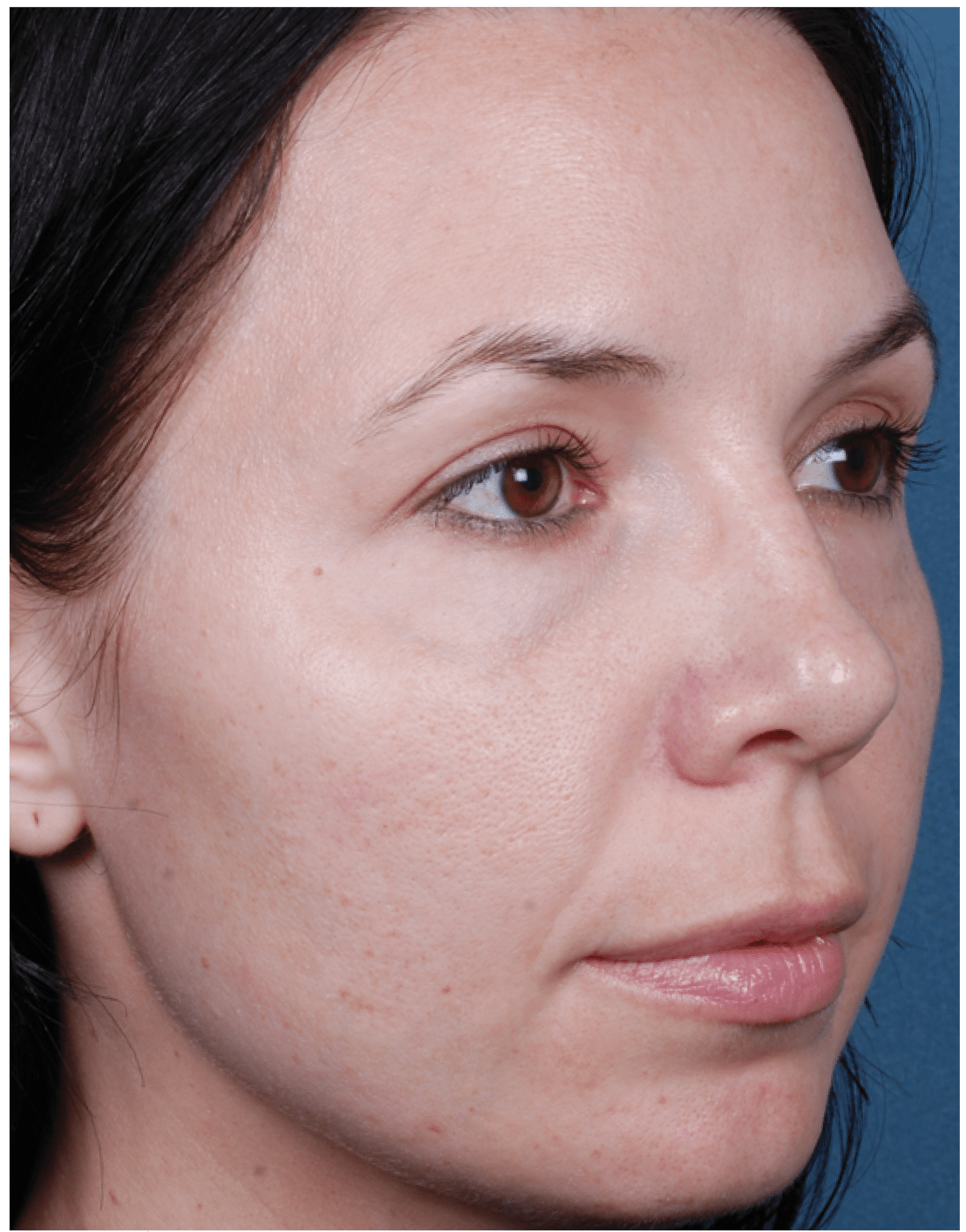 Before and After-Obagi Blue Peel